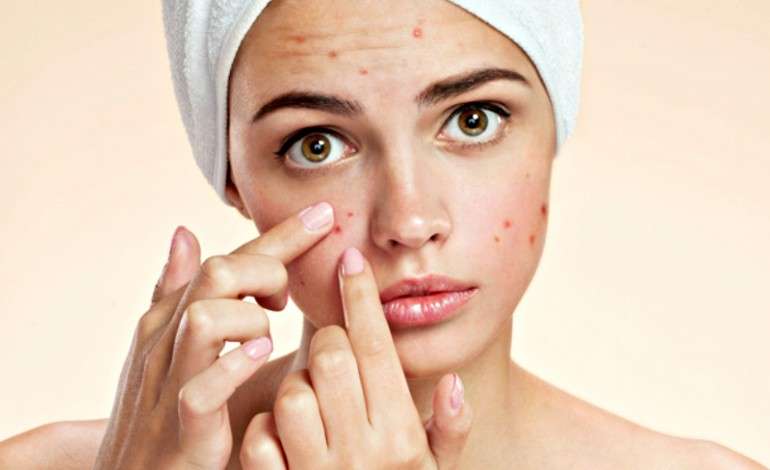 How to Get Rid of Acne Forever: Home and Natural Remedies